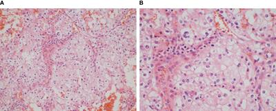 Frontiers Sintilimab Combined With Axitinib In The Treatment Of